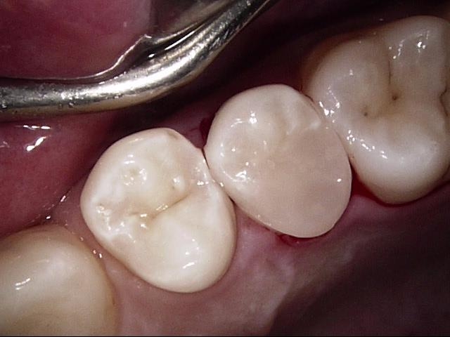 Cleaning Fillings_2