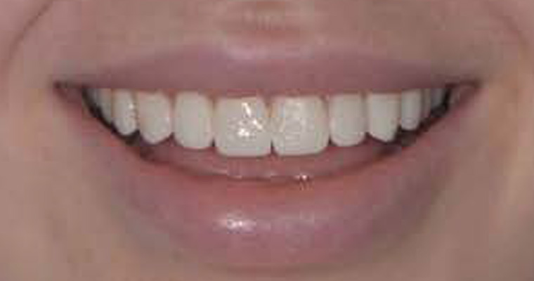 Porcelain After