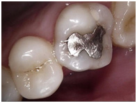 Do we always remove Amalgam?