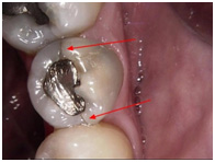 Cracks caused by Amalgam