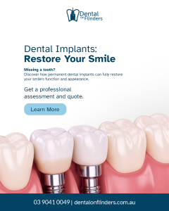 3D model of dental implants in the lower jaw showing porcelain crowns and titanium posts.