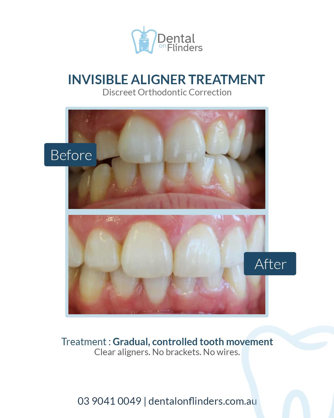 Before and after invisible aligner treatment Melbourne CBD