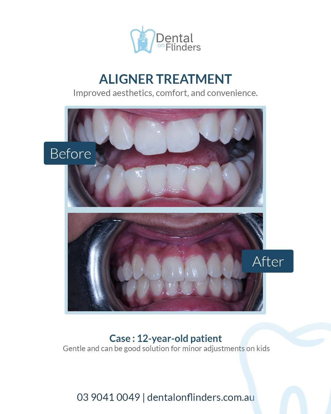 Before and after aligner treatment case 2