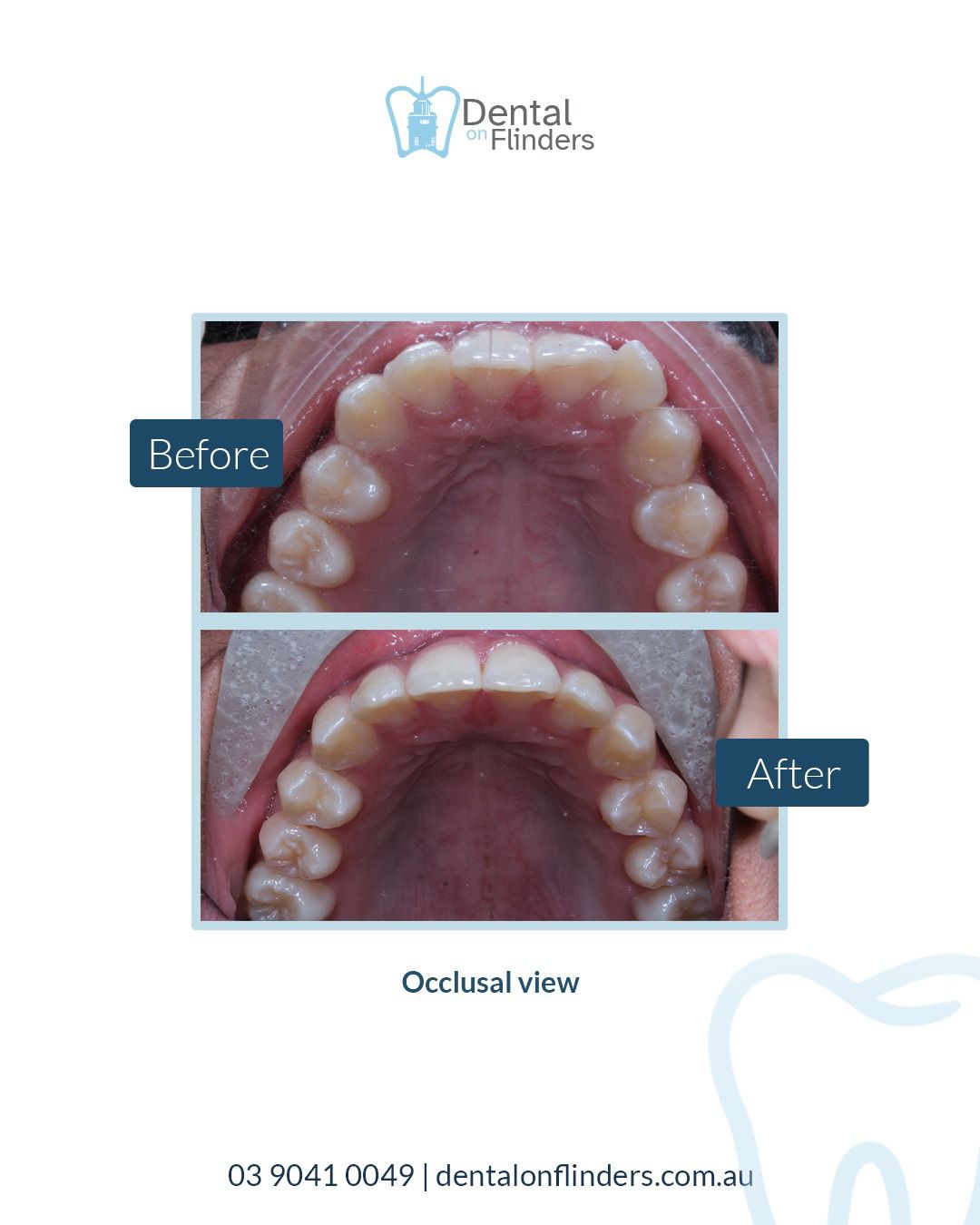 Before and after aligner treatment case 3