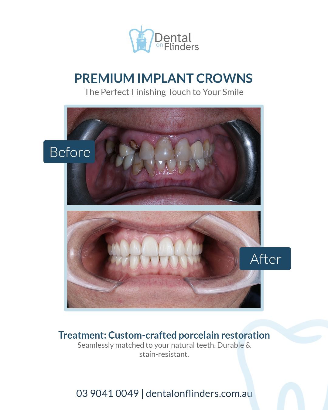 Before and after dental implant Melbourne CBD