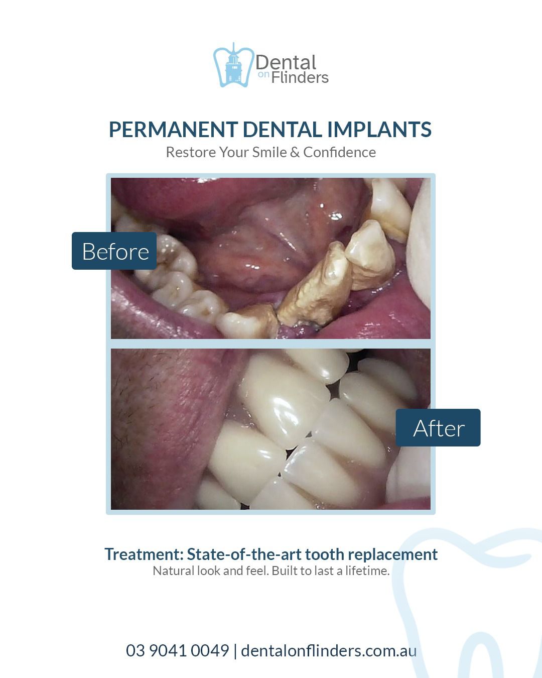 Before and after dental implant case 2