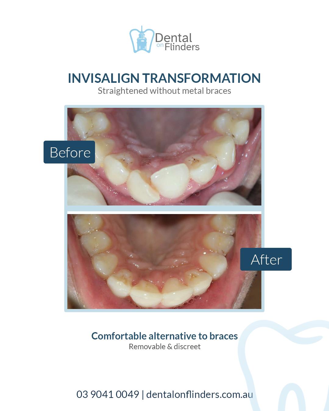 Before and after Invisalign Melbourne CBD