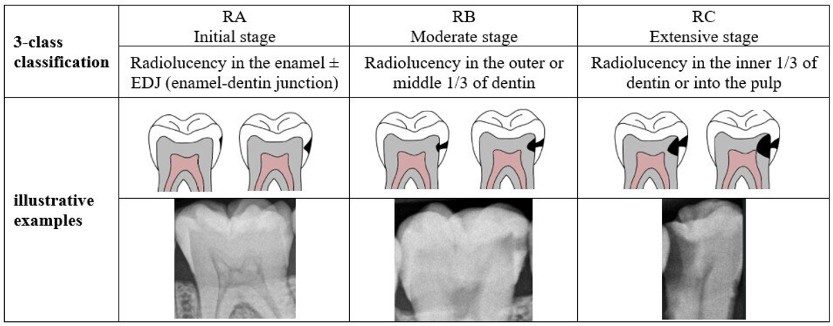 RA classification diagram showing stages of dental decay from RA1 to RA6
